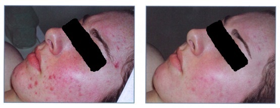 Acne - Before & After - HEAL Wellness Center and Spa