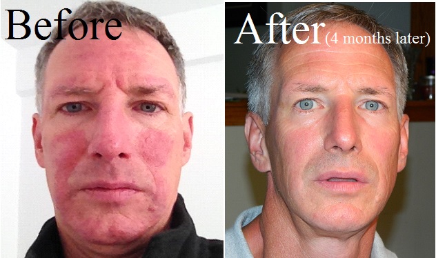 Rosacea - Before & After - HEAL Wellness Center and Spa